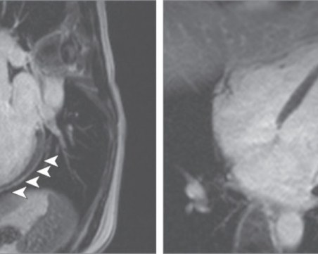 В Германия: 80% от боледувалите от COVID-19 имат възпаление на сърцето