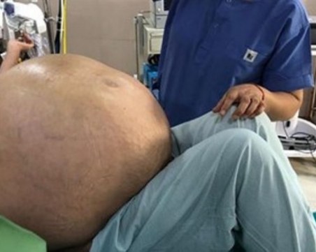 Лекари извадиха най-големия тумор в света