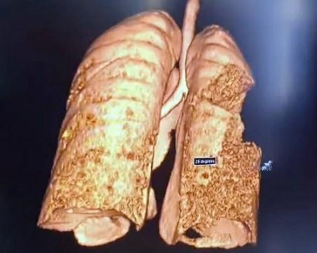 Пулмолог пусна снимка на белите дробове на 22-годишен пациент с коронавирус