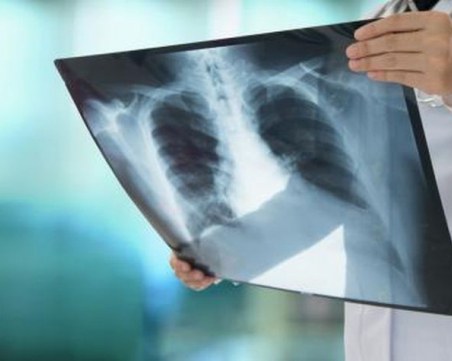 Д-р Иван Тонев: 4000 души годишно чуват диагнозата рак на белия дроб у нас