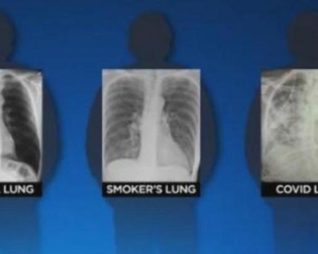 Белите дробове на хората, прекарали коронавирус, изглеждат по-зле от тези на пушачите