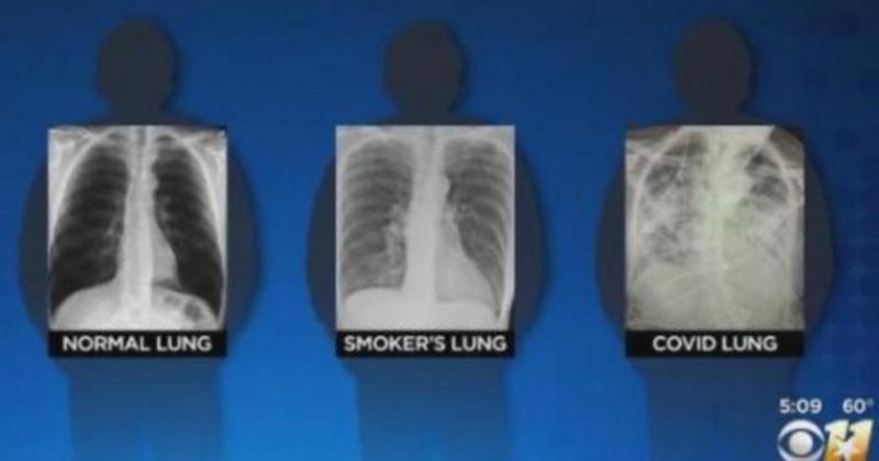 Белите дробове на хората, прекарали коронавирус, изглеждат по-зле от тези на пушачите