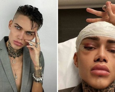 Той похарчи 35 000 евро, за да изглежда лицето му като с филтър от Инстаграм