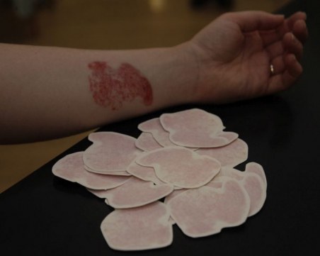 Единствено в България не се покрива домашното лечение при атопичен дерматит