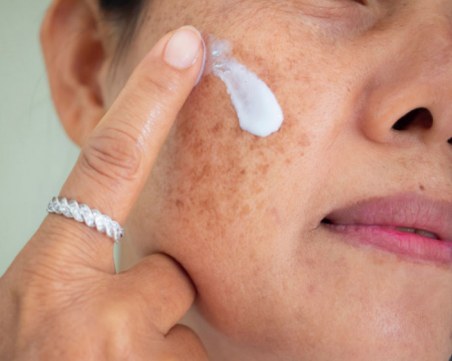 Как да предпазим кожата си от хиперпигментация през лятото