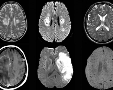 COVID-19 влияе и на мозъка, преболедували имат симптоми, сходни с тези на Алцхаймер