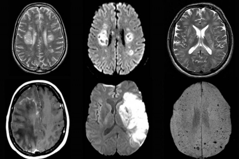 COVID-19 влияе и на мозъка, преболедували имат симптоми, сходни с тези на Алцхаймер