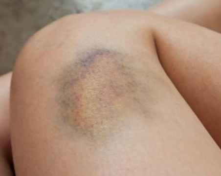 Кога синините са опасни и трябва да посетим лекар