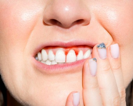 Болните венци повишават риска от други заболявания