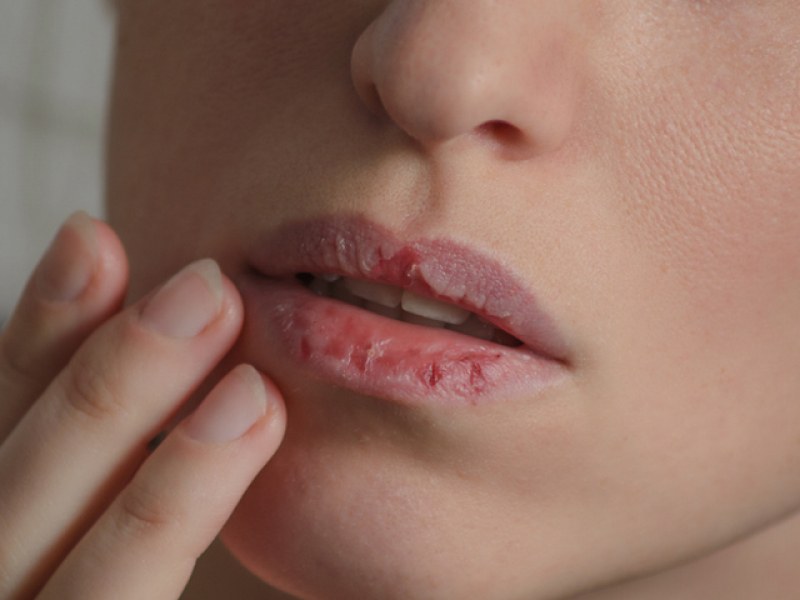 Сухите и напукани устни могат да бъдат сигнал за здравословни проблеми