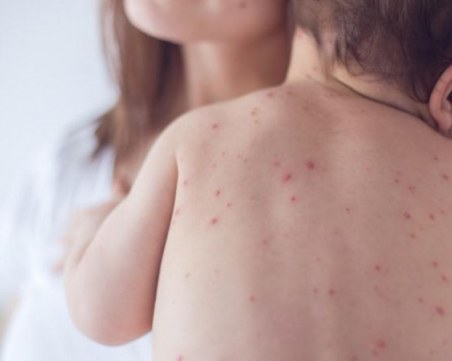 Бум на варицела в Пловдив, може да започне само с температура