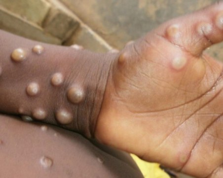 Обединеното кралство потвърди случай на маймунска шарка