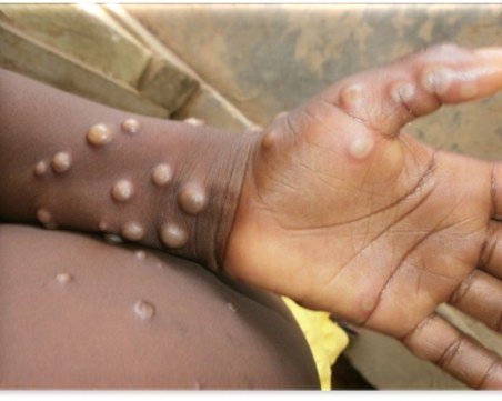 Гърция регистрира първи случай на маймунска шарка