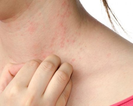 Как да разпознаем слънчева алергия