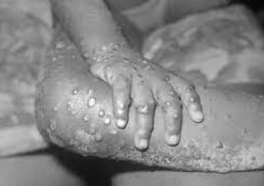 Световната здравна организация препоръчва да се вземат различни мерки срещу