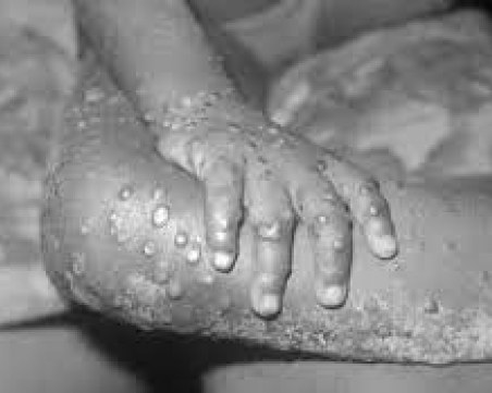 СЗО: Маймунската шарка не е повод за безпокойство