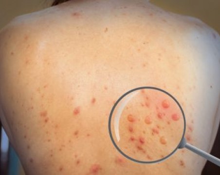 СЗО: Има умерен риск от маймунската шарка