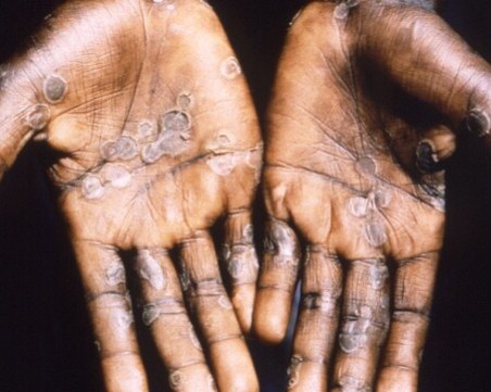 СЗО: Над 1000 са новите случаи на маймунска шарка за месец