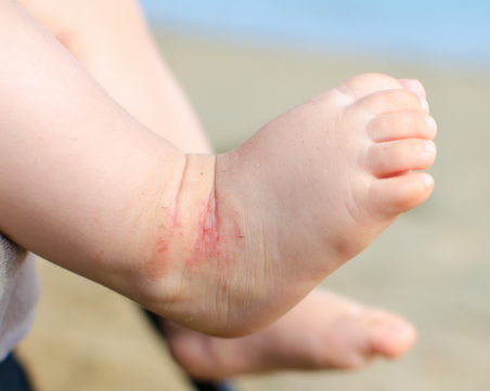 Организират безплатно училище за пациенти и родители на деца с атопичен дерматит в Пловдив