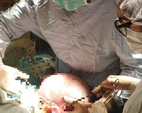 Уникална операция в Пловдив: Отстраниха 7 кг. тумор от яйчника на пациентка в УМБАЛ 