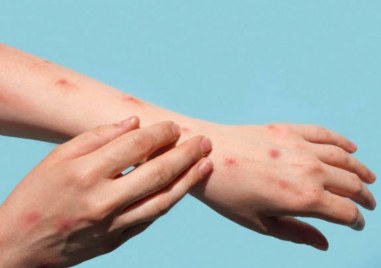 Първи случай на маймунска шарка в Румъния Румънското здравно министерство