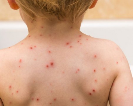 Карантинираха цяла група в детската градина в Крумово заради варицела