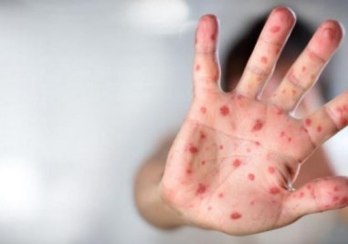 Двамата заболели от маймунска шарка са в добро състояние каза