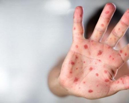 Потвърдиха трети случай на маймунска шарка у нас