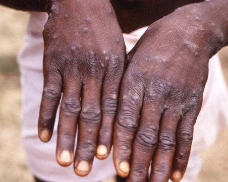 СЗО предупреждава, че маймунската шарка може да е опасна за бременни и деца