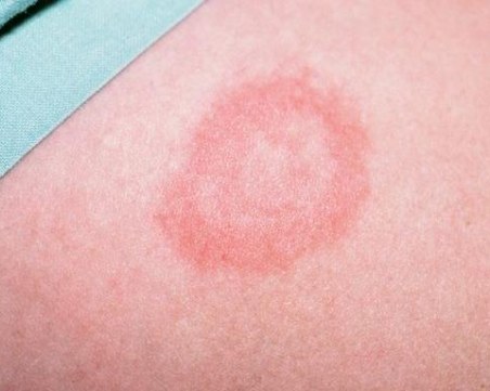 Специалист по инфекциозни болести: Увеличават се случаите на лаймска болест