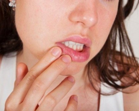 Афтите - какво ги причинява и как да се справим с тях?