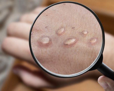 EС започва да снабдява страните с ваксини за маймунска шарка