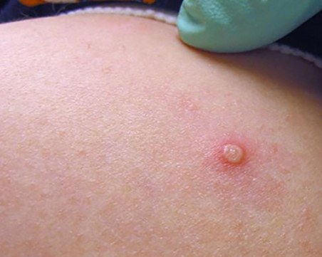 СЗО: Епидемията от маймунска шарка е извънредна ситуация с международно значение