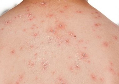 Разпространението на маймунска шарка се превърна в сериозна здравна опасност