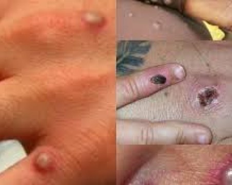 СЗО към мъжете в риск от маймунска шарка: Намалете броя на сексуалните контакти