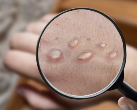 Рекорден брой заразени с маймунска шарка в САЩ за денонощие