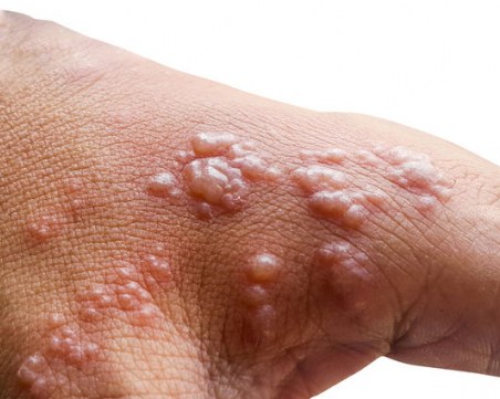 Обявиха извънредно положение в Ню Йорк заради маймунската шарка