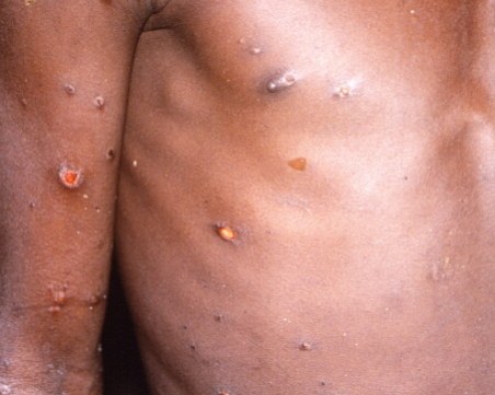 Втори смъртен случай в Испания от маймунска треска