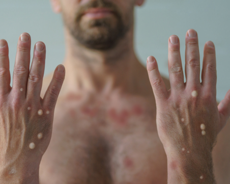 Първи смъртен случай от маймунска шарка в Азия