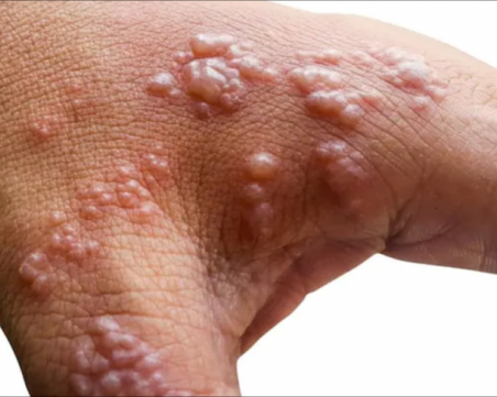 Първи случай на маймунска шарка в Кипър