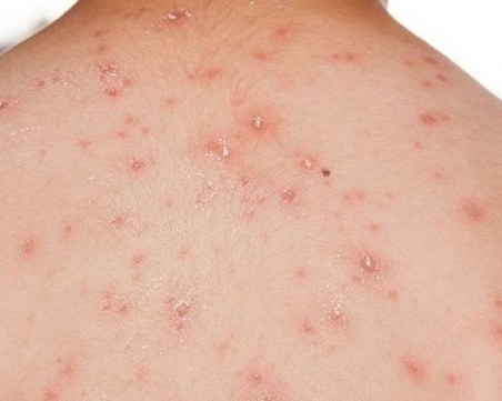 Първи случаи на маймунска шарка в Куба и Индонезия