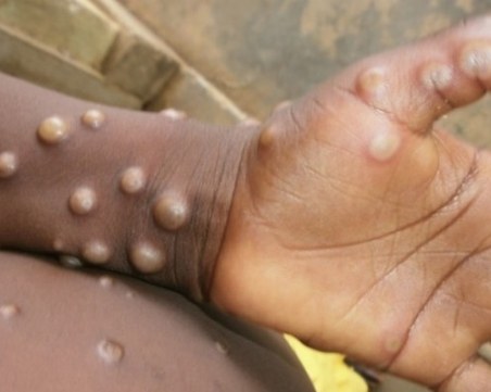 Шести заразен с маймунска шарка у нас