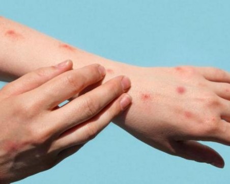 Първи починал от маймунска шарка в САЩ