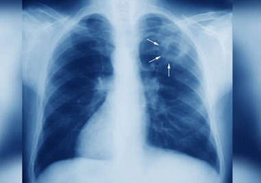 Ръст на случаите на туберкулоза у нас отчитат лечебни заведения