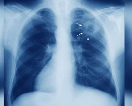 Бум на туберкулозата у нас, пациенти с COVID я откриват случайно при рентген