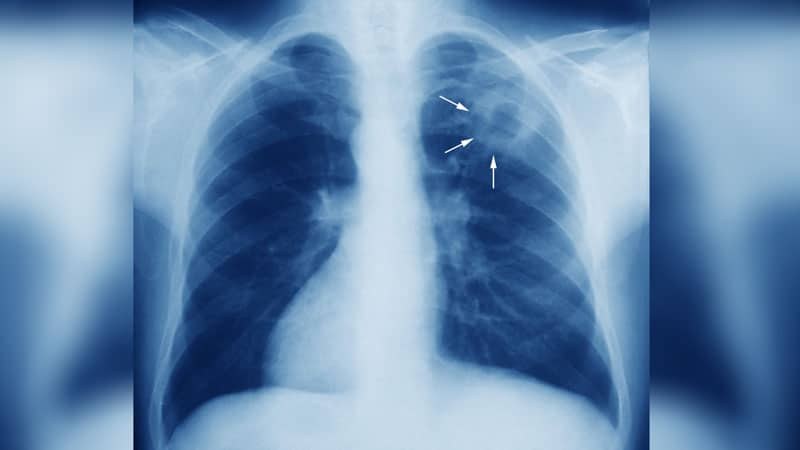 Бум на туберкулозата у нас, пациенти с COVID я откриват случайно при рентген