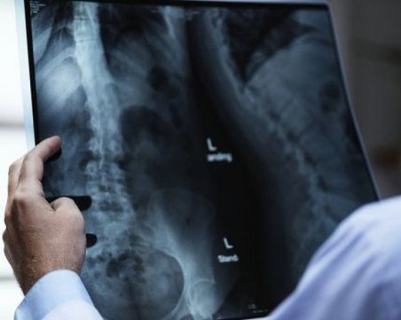 Всяка трета жена над 50 години е засегната от остеопороза