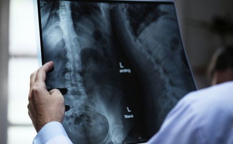 Всяка трета жена над 50 години е засегната от остеопороза