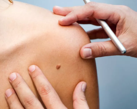 Ако забележите тази промяна в бенката, вземете мерки