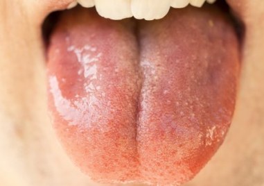 Развалени зъби подути венци и рак на устната кухина близо